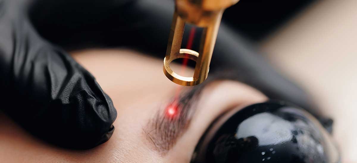 détatouage laser du maquillage permanent des sourcils